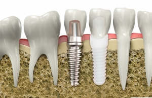 metal free ceramic implant or titanium implant