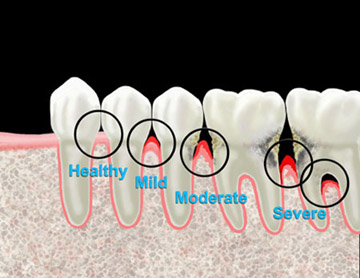 gum disease periodontal disease